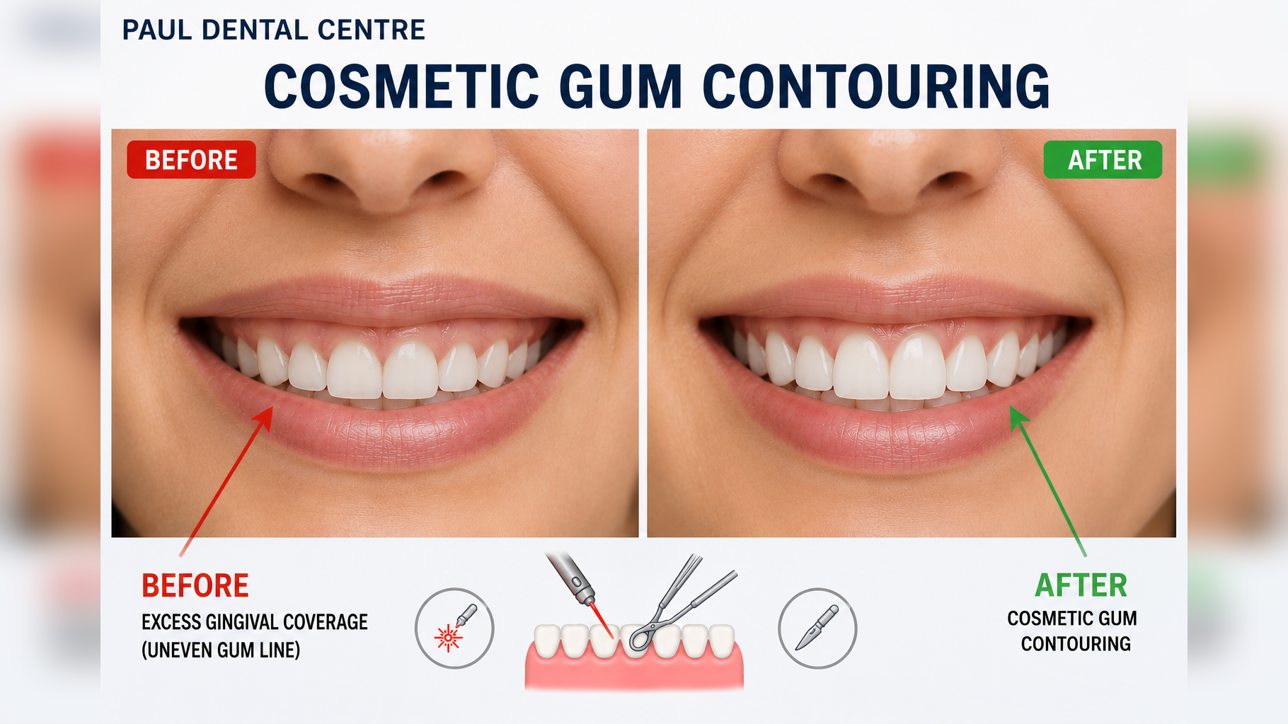Cosmetic Gum Contouring